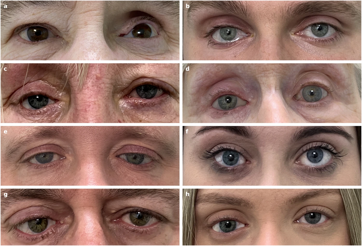 Vergleich von Augenpaaren mit und ohne Augenprothese